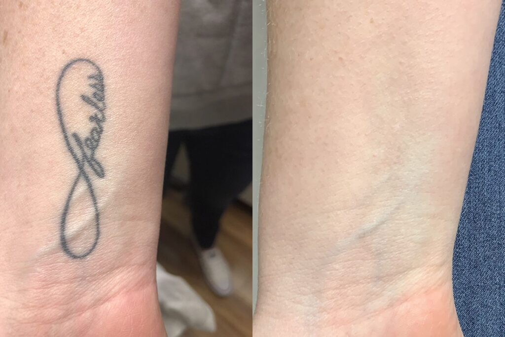 PicoSure Tattoo Removal before and after photo by Dr. Stephen O’Connell in Bellevue, WA