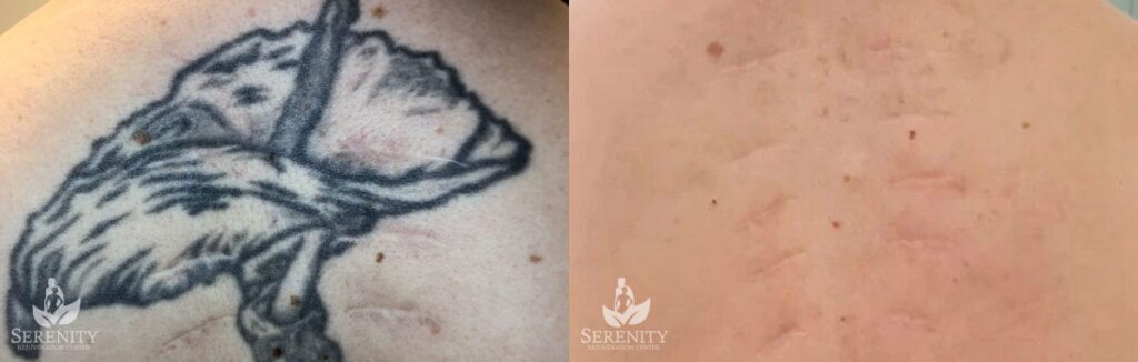 PicoSure Tattoo Removal before and after photo by Dr. Stephen O’Connell in Bellevue, WA