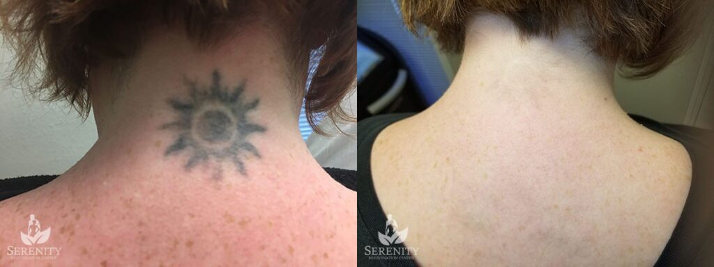 PicoSure Tattoo Removal before and after photo by Dr. Stephen O’Connell in Bellevue, WA