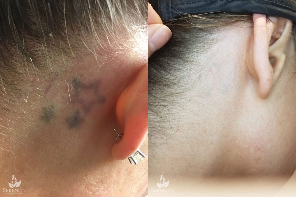 PicoSure Tattoo Removal before and after photo by Dr. Stephen O’Connell in Bellevue, WA