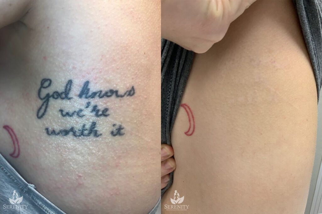 PicoSure Tattoo Removal before and after photo by Dr. Stephen O’Connell in Bellevue, WA