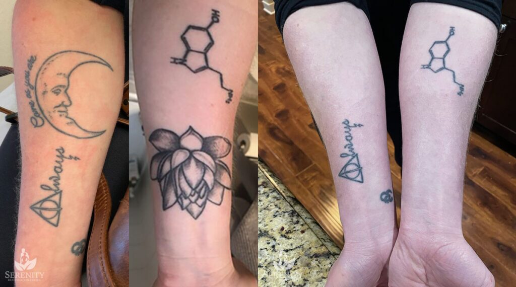 PicoSure Tattoo Removal before and after photo by Dr. Stephen O’Connell in Bellevue, WA