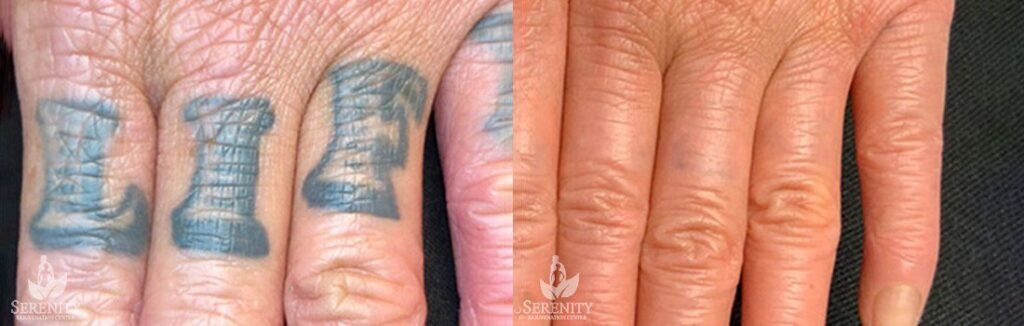 PicoSure Tattoo Removal before and after photo by Dr. Stephen O’Connell in Bellevue, WA