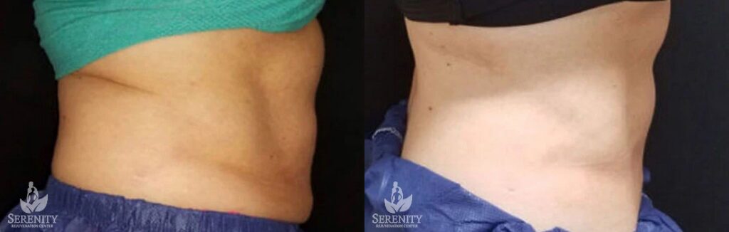 CoolSculpting before and after photo by Dr. Stephen O’Connell in Bellevue, WA