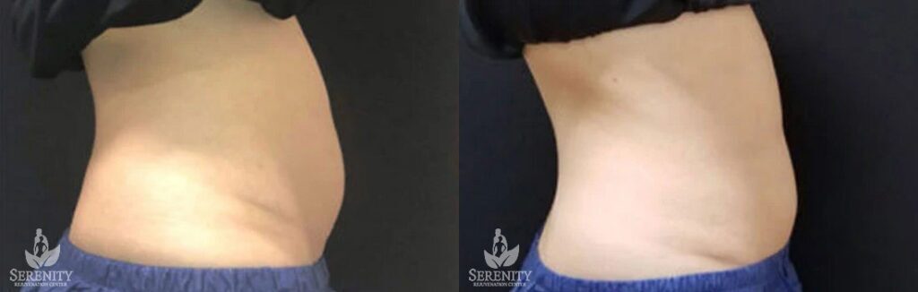 CoolSculpting before and after photo by Dr. Stephen O’Connell in Bellevue, WA