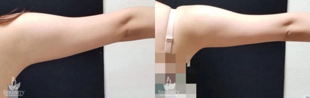 CoolSculpting before and after photo by Dr. Stephen O’Connell in Bellevue, WA