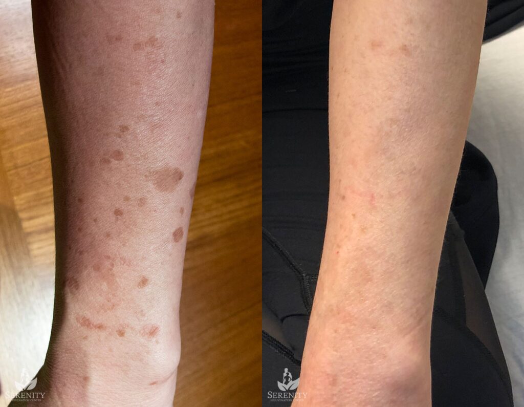 PicoSure® Pro Focus before and after photo by Dr. Stephen O’Connell in Bellevue, WA