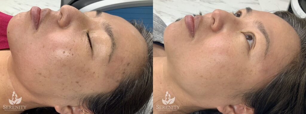 PicoSure® Pro Focus before and after photo by Dr. Stephen O’Connell in Bellevue, WA