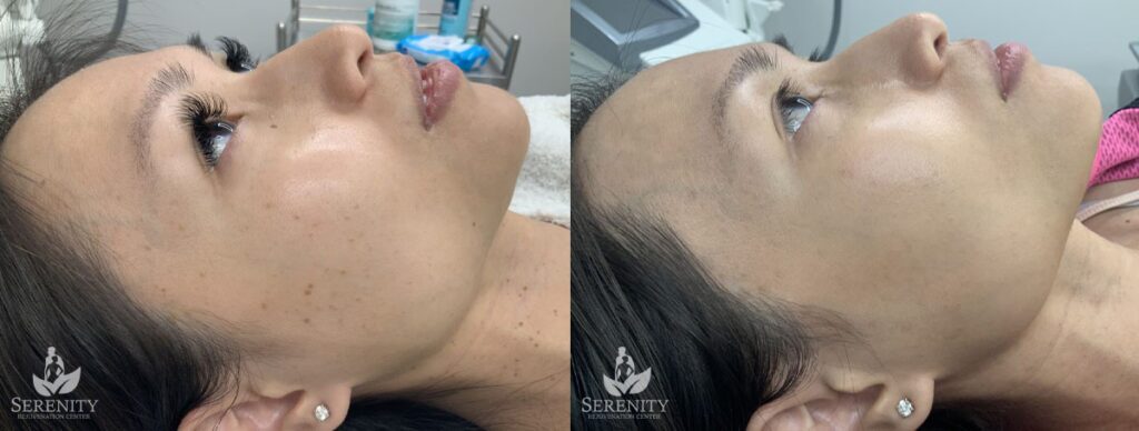 PicoSure® Pro Focus before and after photo by Dr. Stephen O’Connell in Bellevue, WA