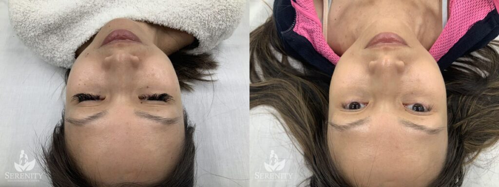 PicoSure® Pro Focus before and after photo by Dr. Stephen O’Connell in Bellevue, WA