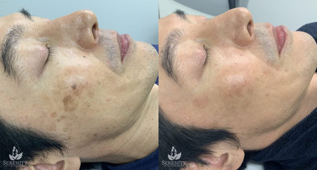 PicoSure® Pro Focus before and after photo by Dr. Stephen O’Connell in Bellevue, WA