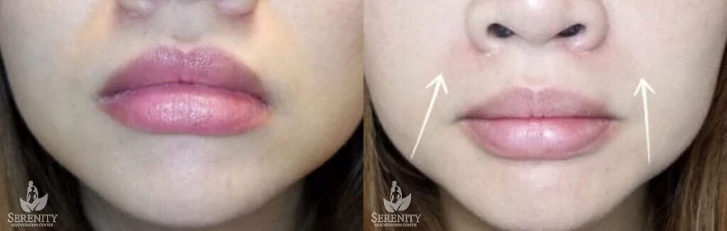 Dermal Fillers before and after photo by Dr. Stephen O’Connell in Bellevue, WA