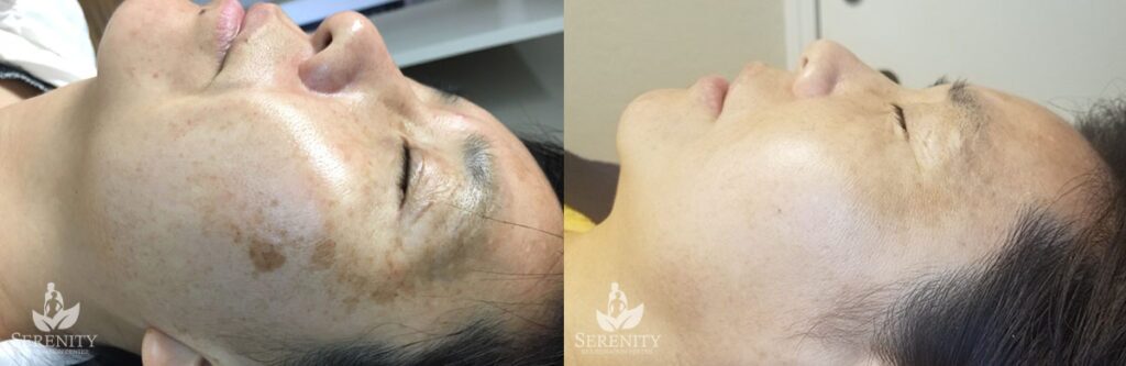 PicoSure® Pro Focus before and after photo by Dr. Stephen O’Connell in Bellevue, WA