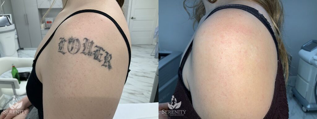 PicoSure Tattoo Removal before and after photo by Dr. Stephen O’Connell in Bellevue, WA