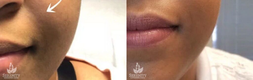 Dermal Fillers before and after photo by Dr. Stephen O’Connell in Bellevue, WA