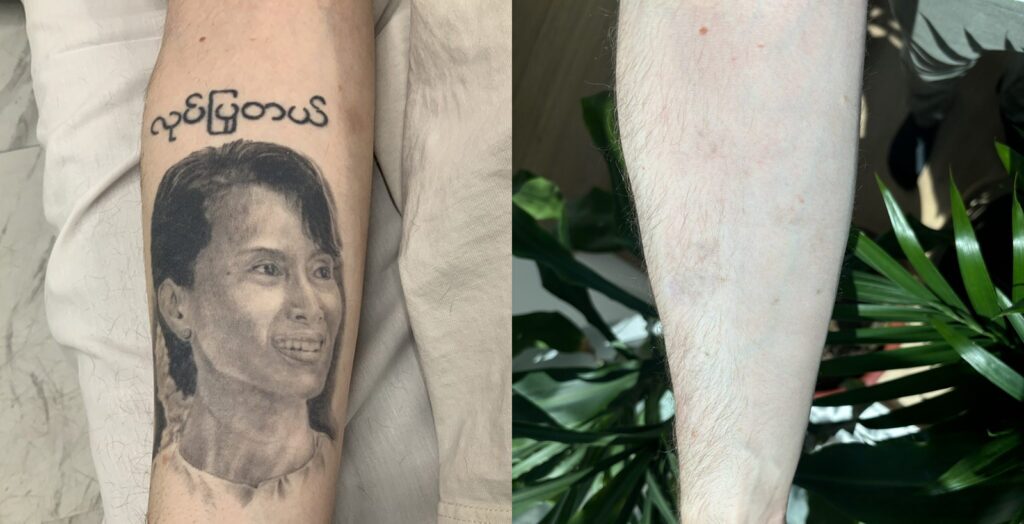 PicoSure Tattoo Removal before and after photo by Dr. Stephen Oconnell in Bellevue WA