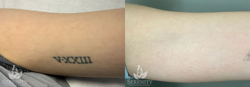 Picosure Tattoo Removal before and after photo by Dr. Stephen Oconnell in Bellevue WA