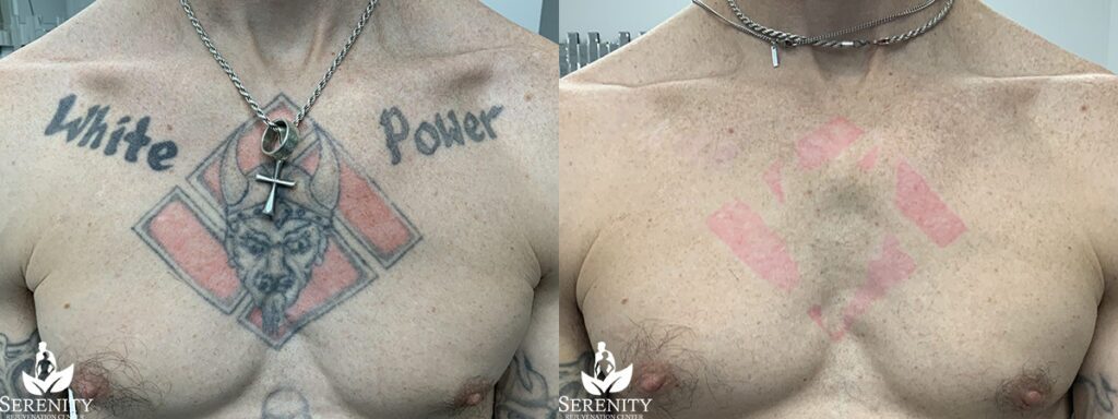 Picosure Tattoo Removal before and after photo by Dr. Stephen Oconnell in Bellevue WA