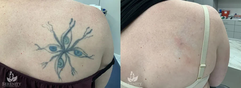 Picosure Tattoo Removal before and after photo by Dr. Stephen Oconnell in Bellevue WA