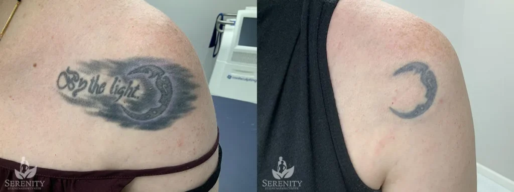 Picosure Tattoo Removal before and after photo by Dr. Stephen Oconnell in Bellevue WA