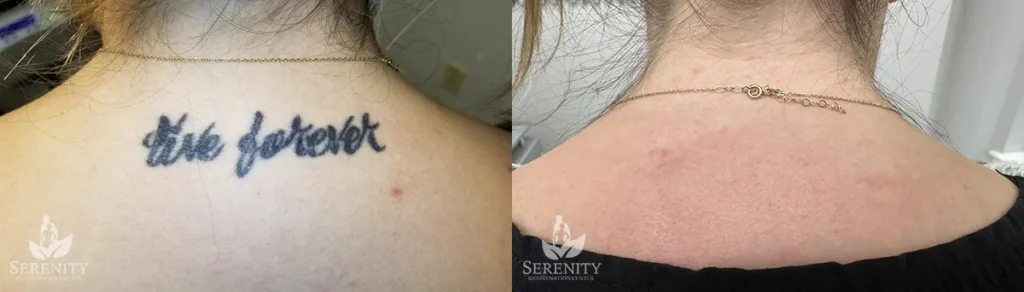 Picosure Tattoo Removal before and after photo by Dr. Stephen Oconnell in Bellevue WA