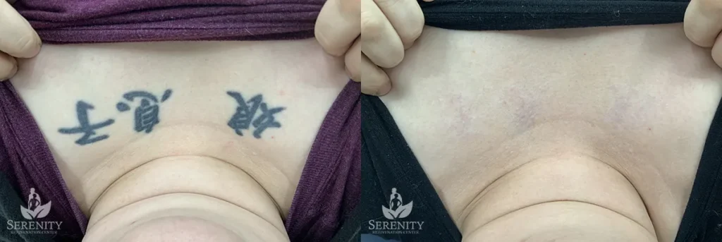 Picosure Tattoo Removal before and after photo by Dr. Stephen Oconnell in Bellevue WA